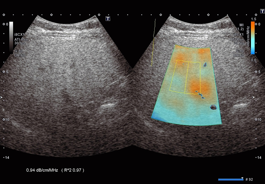 Diagnostic images of fatty liver using ATI (The attenuation of the ultrasonic pulse in the specified area is shown in color. The equipment achieves displaying the measurement results in numbers by calculating the attenuation coefficient.)