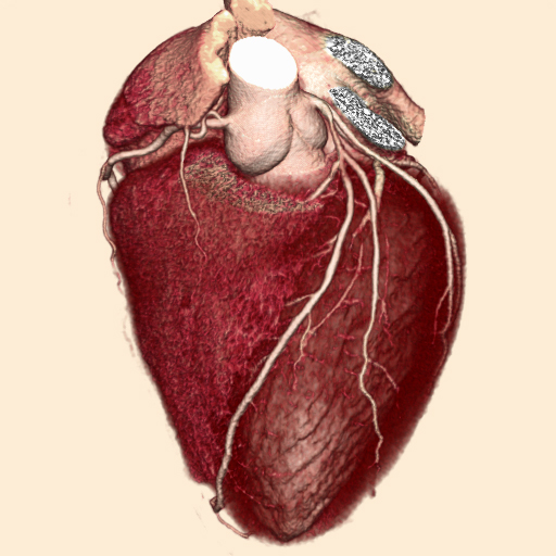 Clinical image of the heart reconstructed from data acquired in a single rotation by a 320-row CT system