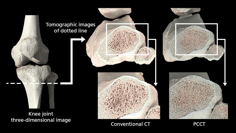 Image obtained using conventional CT and image obtained using PCCT