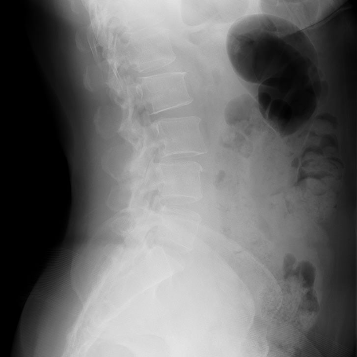 Myelogram using conventional fluoroscopy