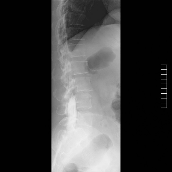 Myelogram of the same patient using Canon Medical's digital fluoroscopy system