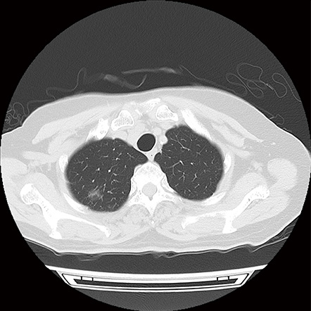 Chest image acquired by PCCT